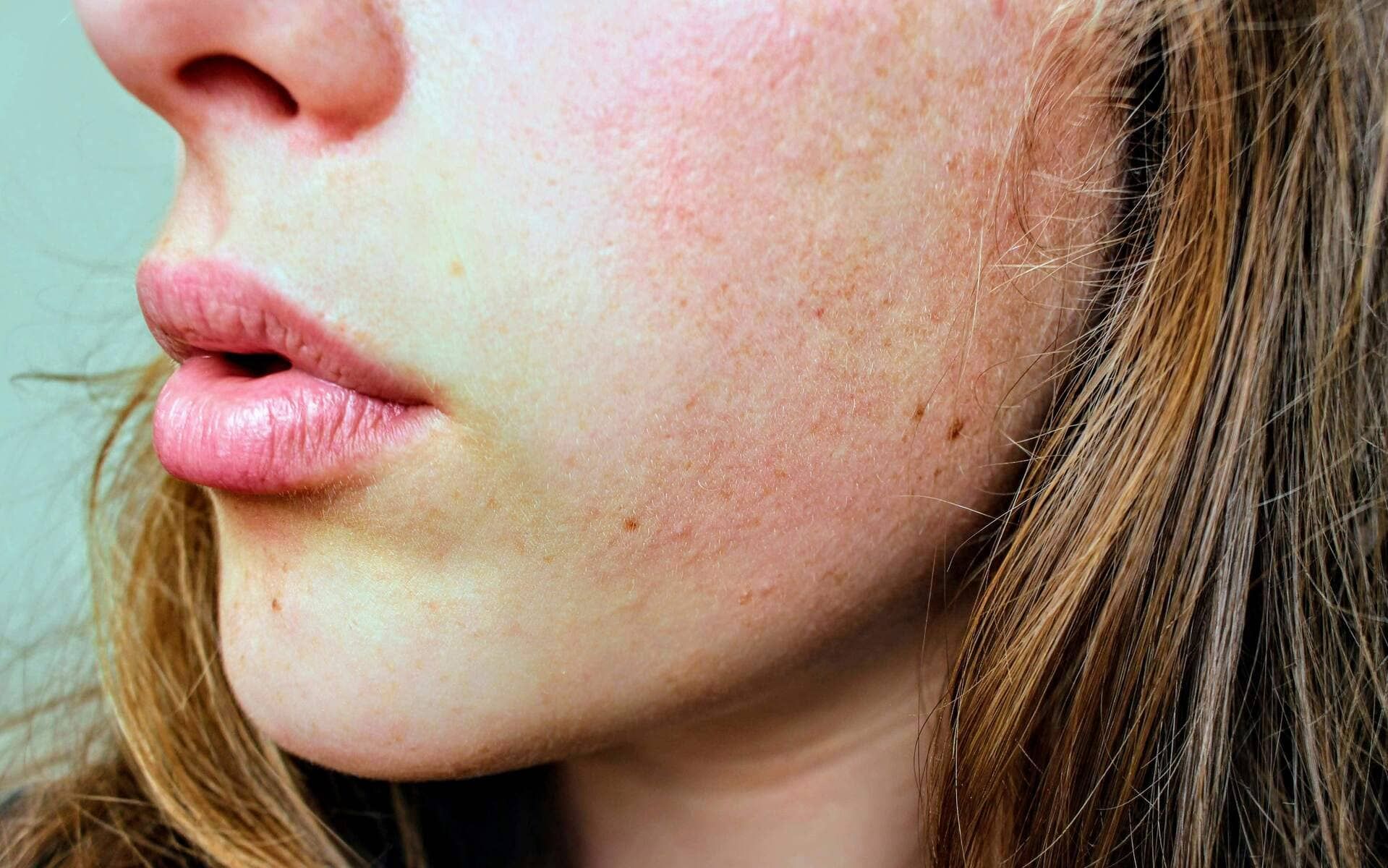 Cold Sore from Stress: Why It Happens and What to Do